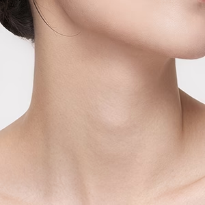 Neck Wrinkles
